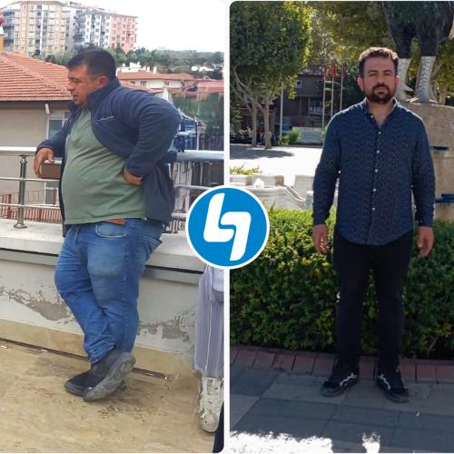تكميم المعدة صور ماقبل / ما بعد